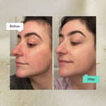 "Benefits of hyaluronic acid serum plump skin
